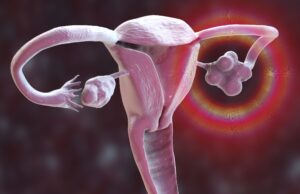 What Is Polycystic Ovary Syndrome? New name, PMOS Explained what-is-polycystic-ovary-syndrome?-new-name,-pmos-explained