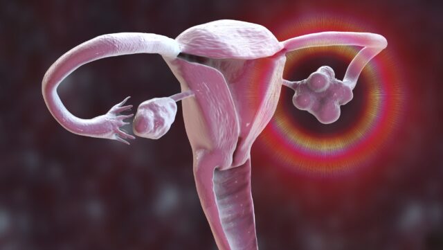 what-is-polycystic-ovary-syndrome?-new-name,-pmos-explained